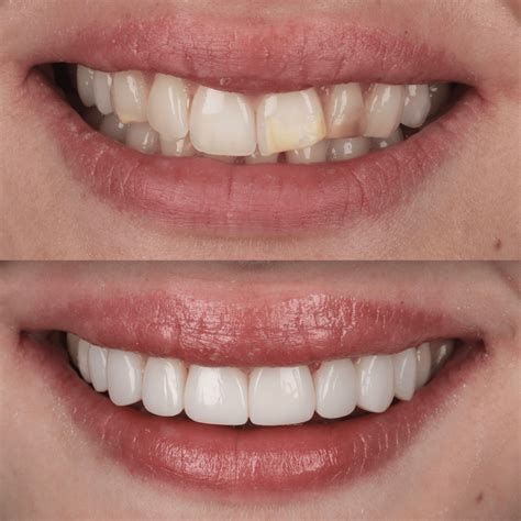 composite veneers near me|veneers for teeth cost.